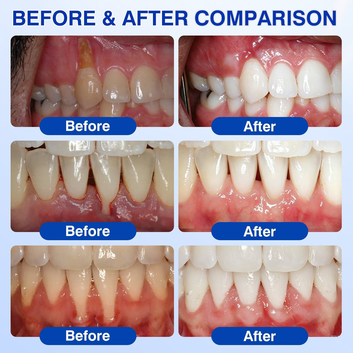 🦷 Evolvion® GumVital Advanced Gum Care Gel + 🎁 FREE Gum Care Kit